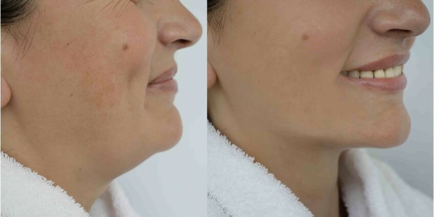 Lipo de Papada: Procedimento, Custos e a Importância da Máscara no Pós-Operatório Lipo de Papada: Procedimento, Custos e a Importância da Máscara no Pós-Operatório